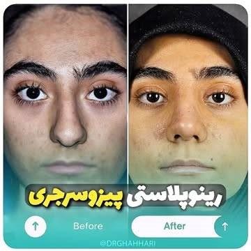 نمونه جراحی بینی 2