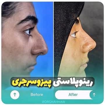 نمونه جراحی بینی