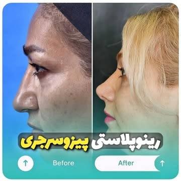 نمونه رینوپلاستی 2
