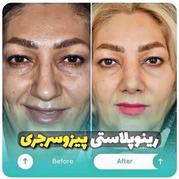 نمونه رینوپلاستی