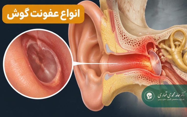 انواع عفونت گوش کدام است؟