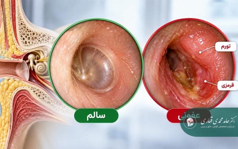 تشخیص عفونت خارجی گوش