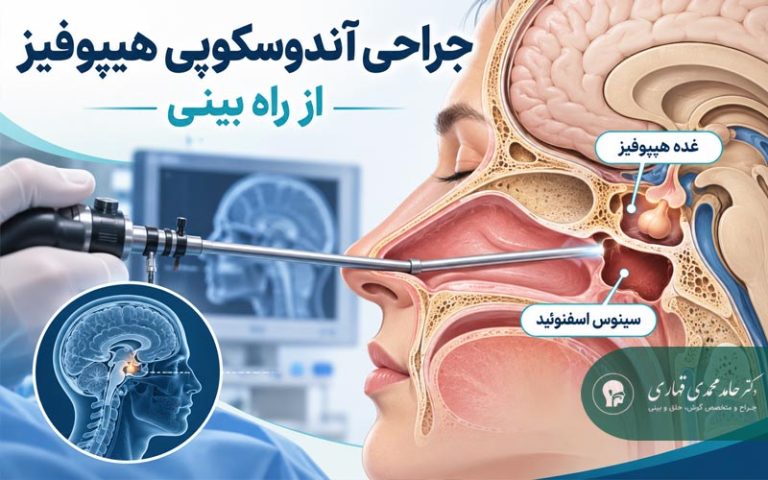 جراحی آندوسکوپی هیپوفیز از راه بینی