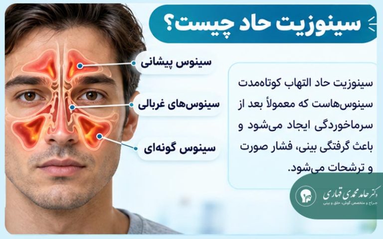سینوزیت حاد چیست
