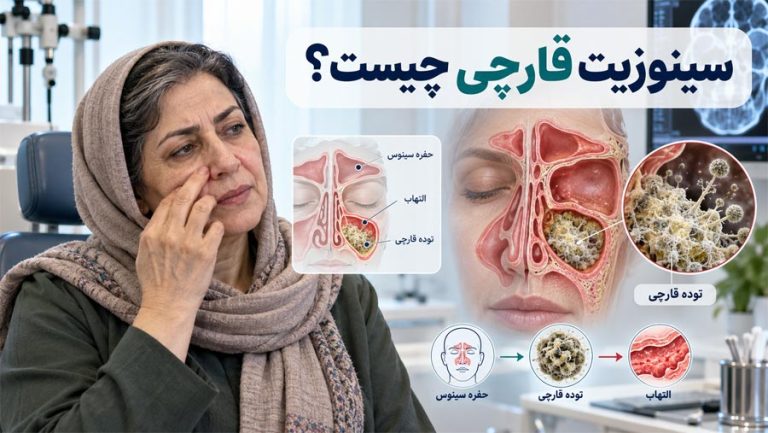 سینوزیت قارچی چیست؟