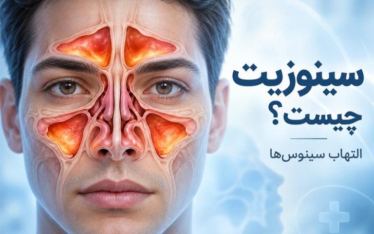 سینوزیت چیست؟